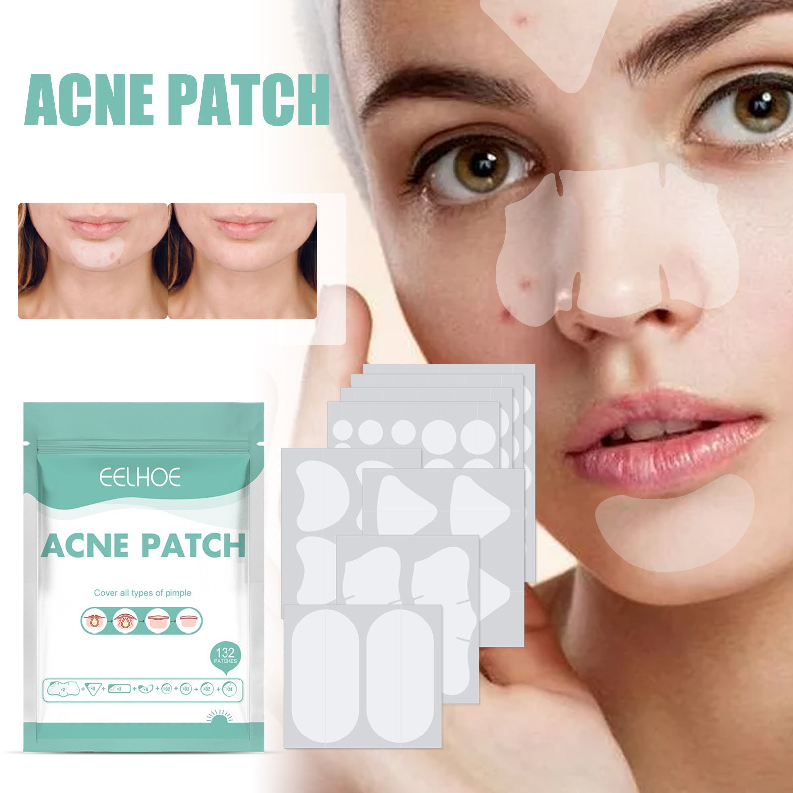 Gentle Acne Relief Patches for Healing and Clearer Skin