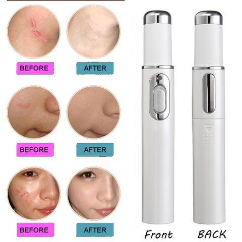 Blue Light Acne & Scar Treatment Laser Pen