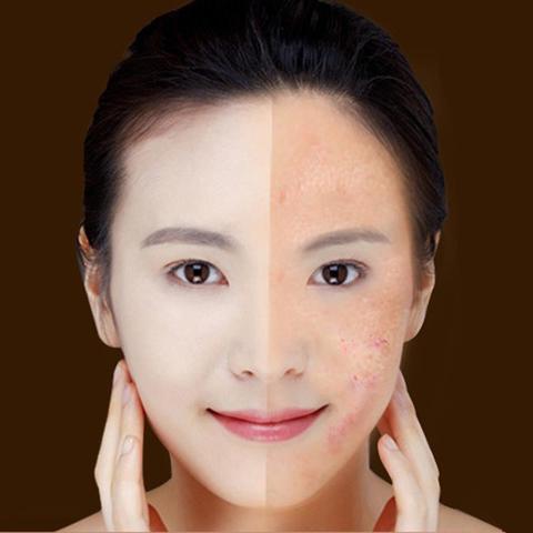 Blue Light Acne & Scar Treatment Laser Pen